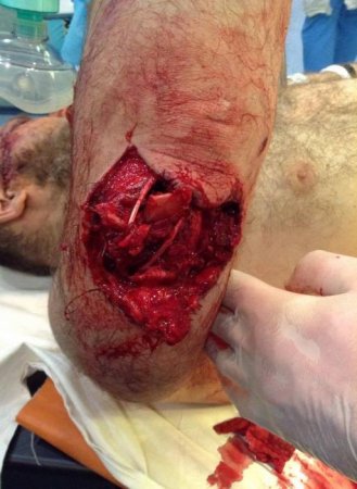 Днепропетровский хирург опубликовал снимок страшного ранения Яроша (СЛАБОНЕРВНЫМ НЕ СМОТРЕТЬ 21+)