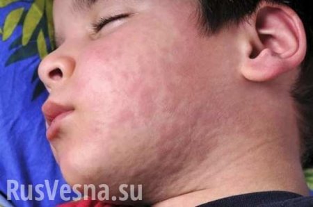 Корь-убийца и польский гепатит: Украину атаковали болезни, от которых уже умирают дети (ВИДЕО)