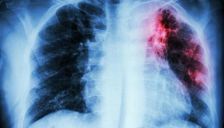 В Польше опасаются эпидемии туберкулеза со стороны Украины