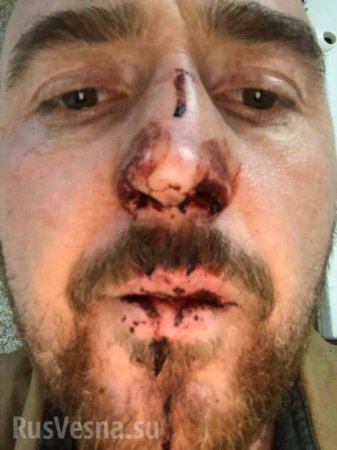 «Сломал нос и душил»: украинского актёра в Польше жестоко избил работодатель (ФОТО)