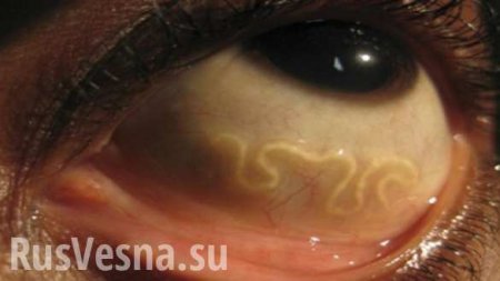 У женщины в глазах завелись черви: учёные опасаются распространения редкой инфекции (ФОТО)