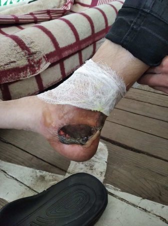 Спасатель из Чернобыля показал жуткие последствия своей работы: чёрные руки и обожжённые до дыр ноги (ФОТО 18+)